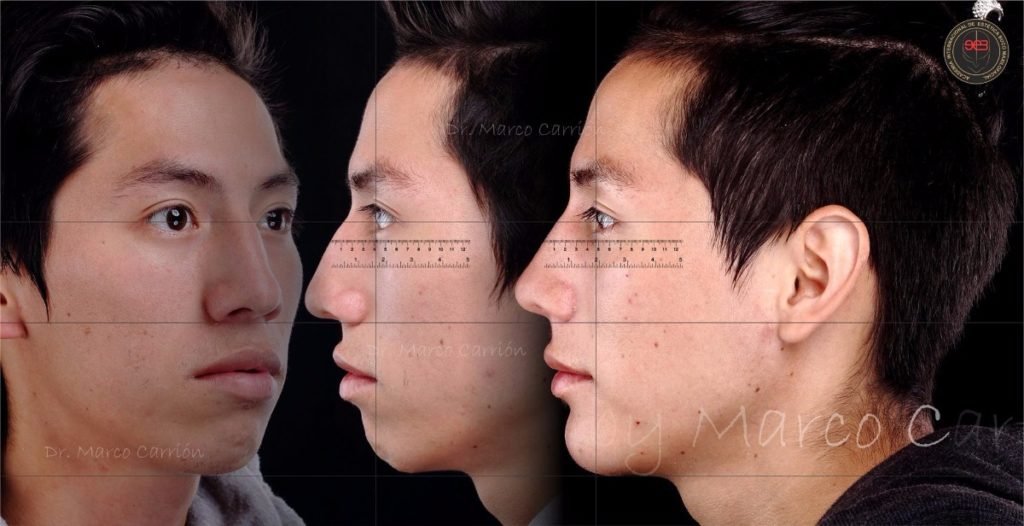 Harmonização Orofacial