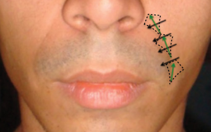 Harmonização Orofacial